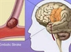 Đột quỵ não - Điều trị đúng cách để tránh biến chứng