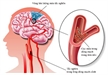 Ðề phòng rối loạn tuần hoàn não